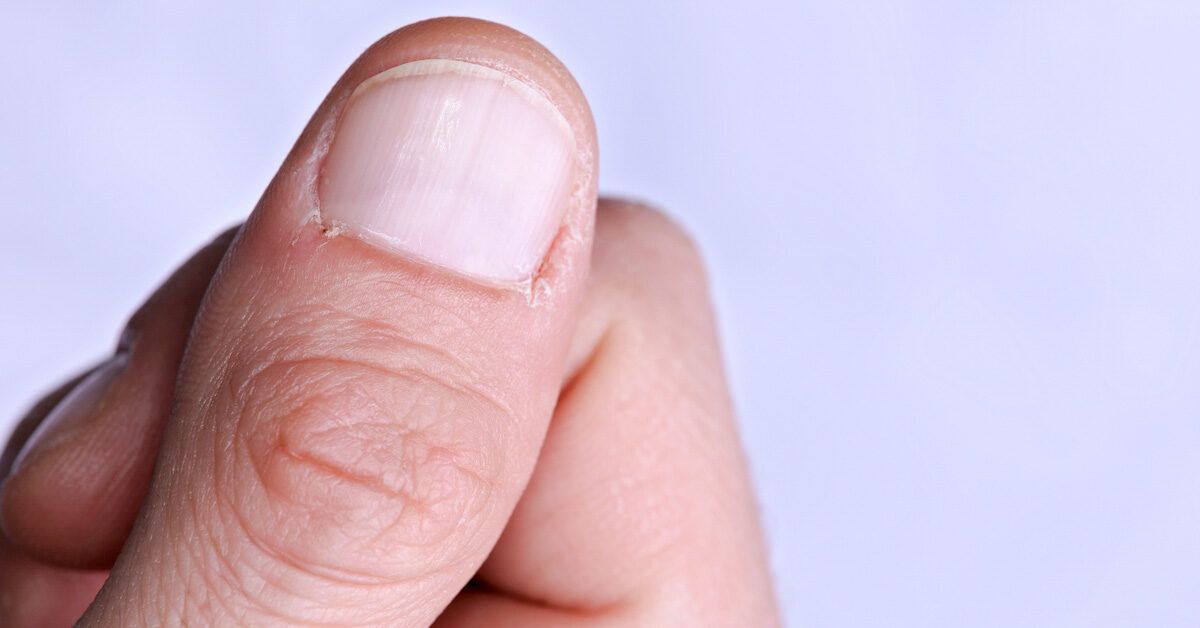Understanding Onychauxis: How to Manage Thickened and Discolored Nails