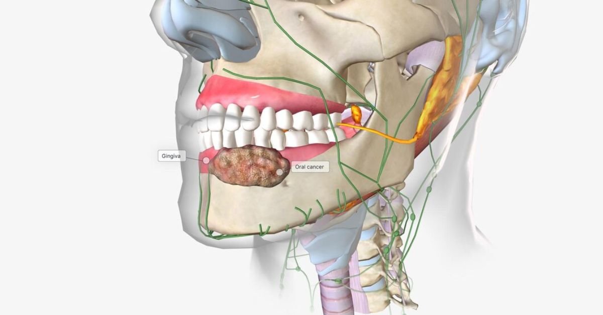 Bone Spicules Explained: Types, Causes, and Prevention Tips