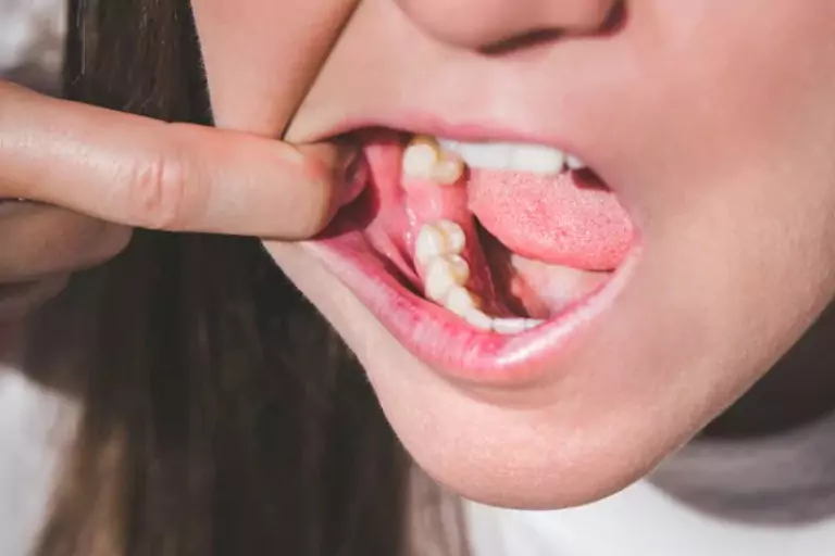 Bone Spicules Explained: Types, Causes, and Prevention Tips
