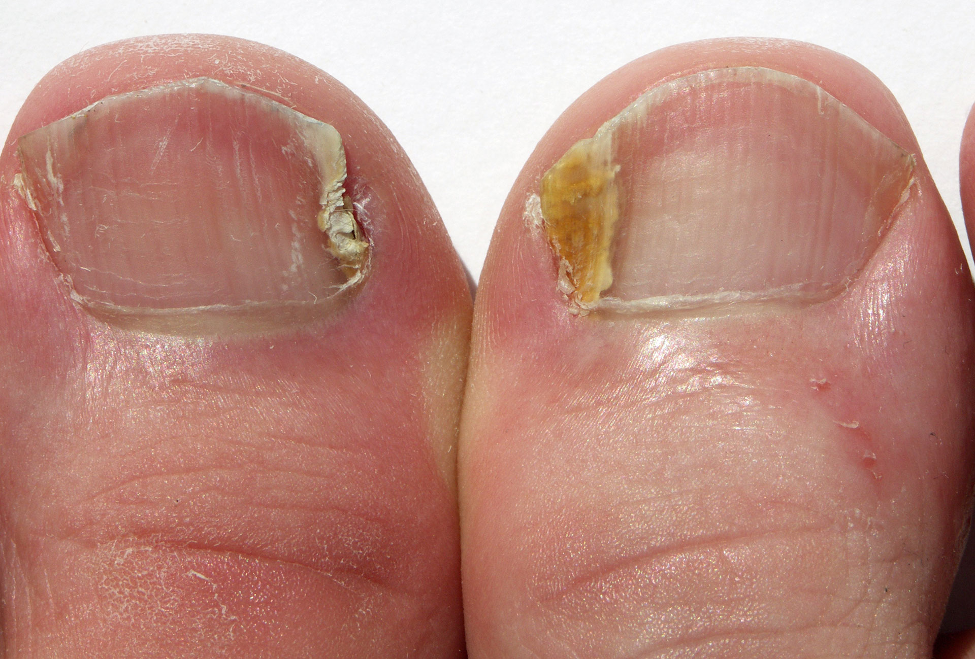 Understanding Onychauxis: How to Manage Thickened and Discolored Nails