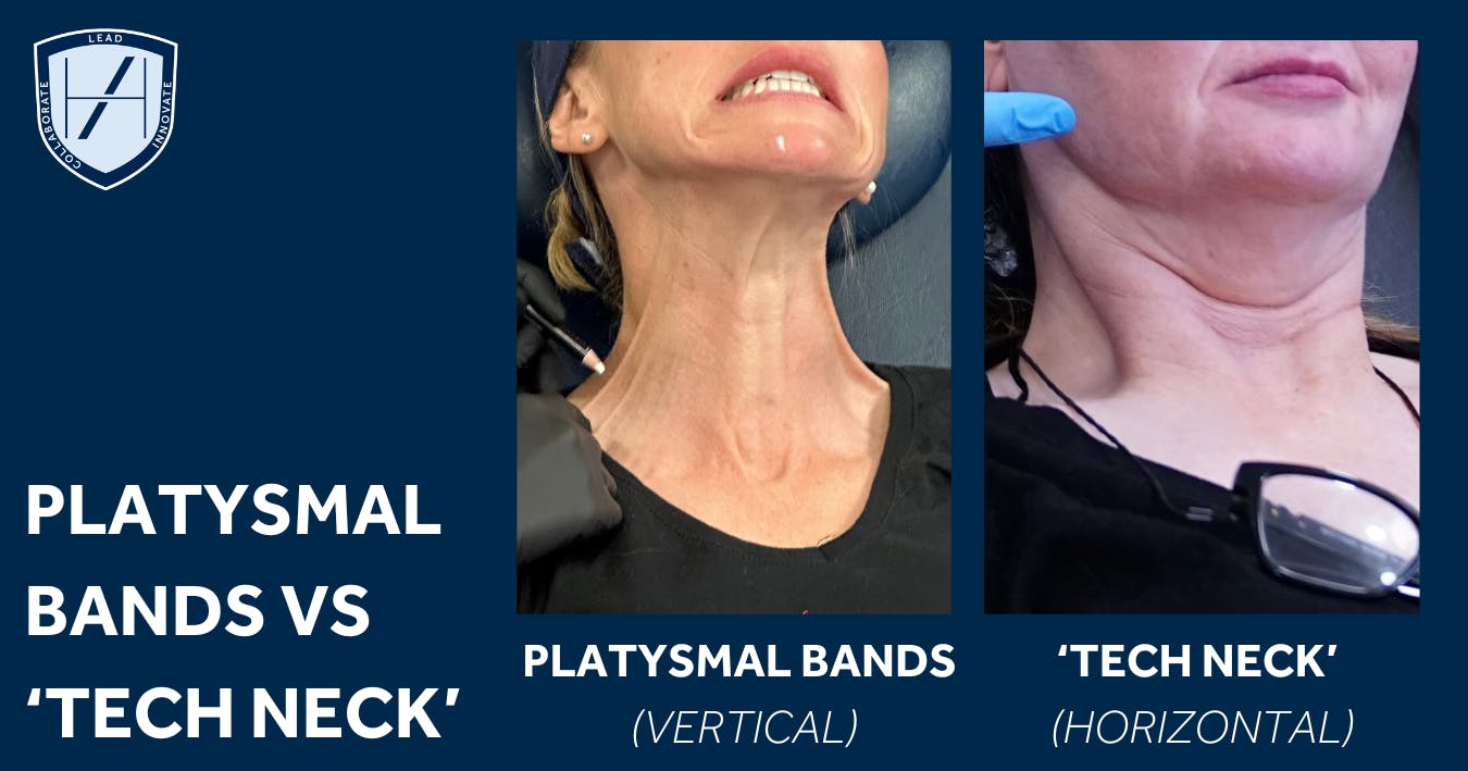 platysmal bands