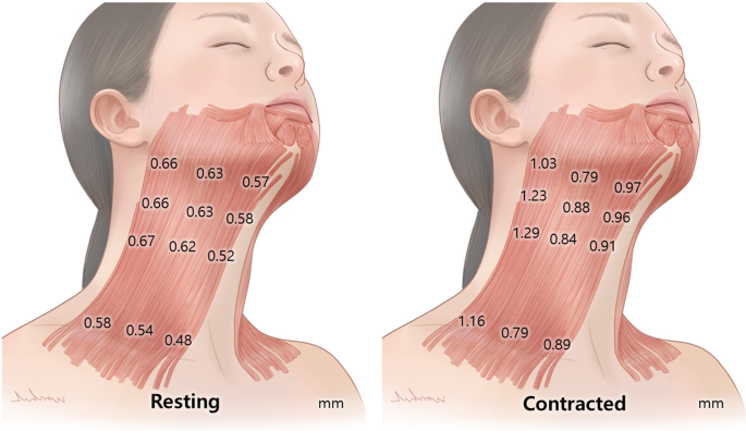 platysmal bands