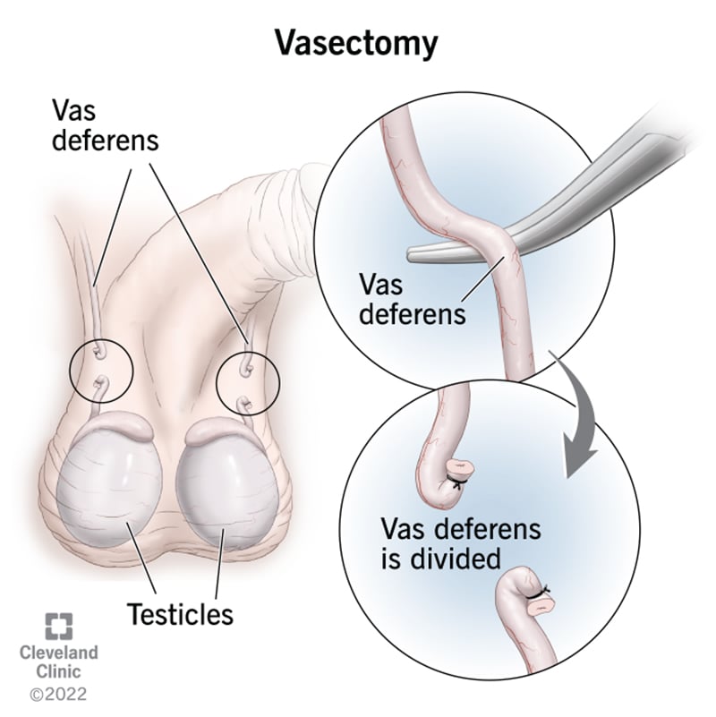 Looking for a Free Vasectomy Near You? Explore Local Options