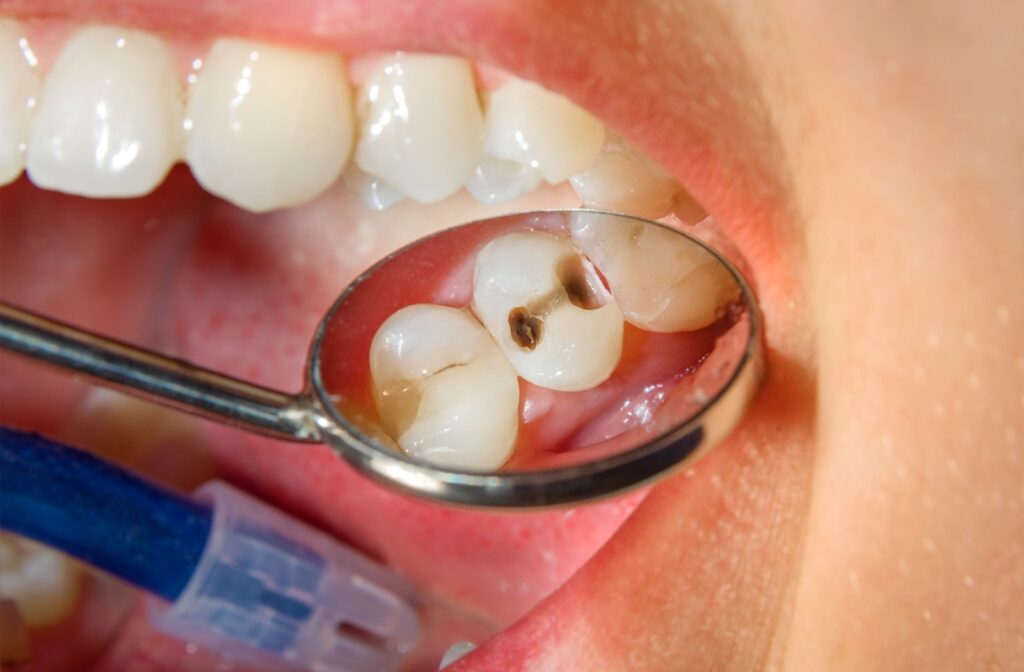 How Long Will It Take to Fill a Cavity at the Dentist?