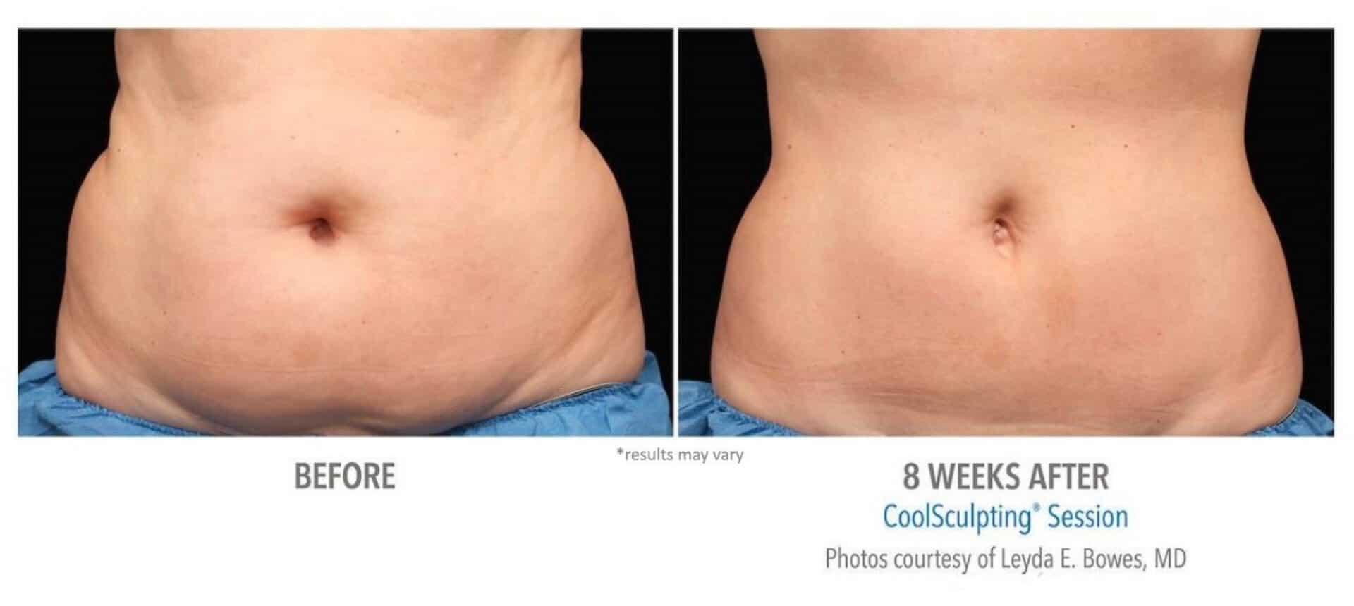 Real CoolSculpting Results: Before and After Photos of Fat-Freezing Success