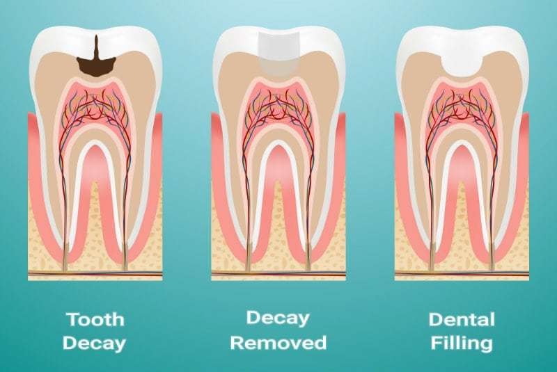 How Long Will It Take to Fill a Cavity at the Dentist?