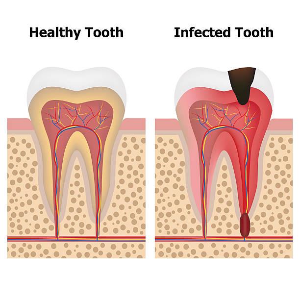Understanding the Timeline： How Long Until a Tooth Infection Poses a Serious Risk？