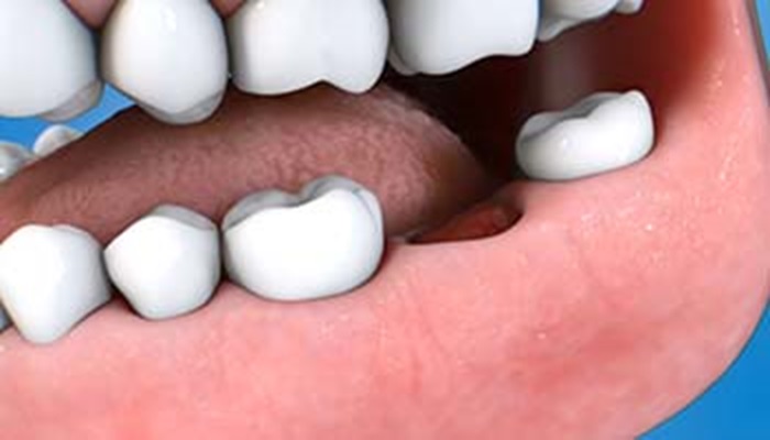 Bone Spicules Explained: Types, Causes, and Prevention Tips
