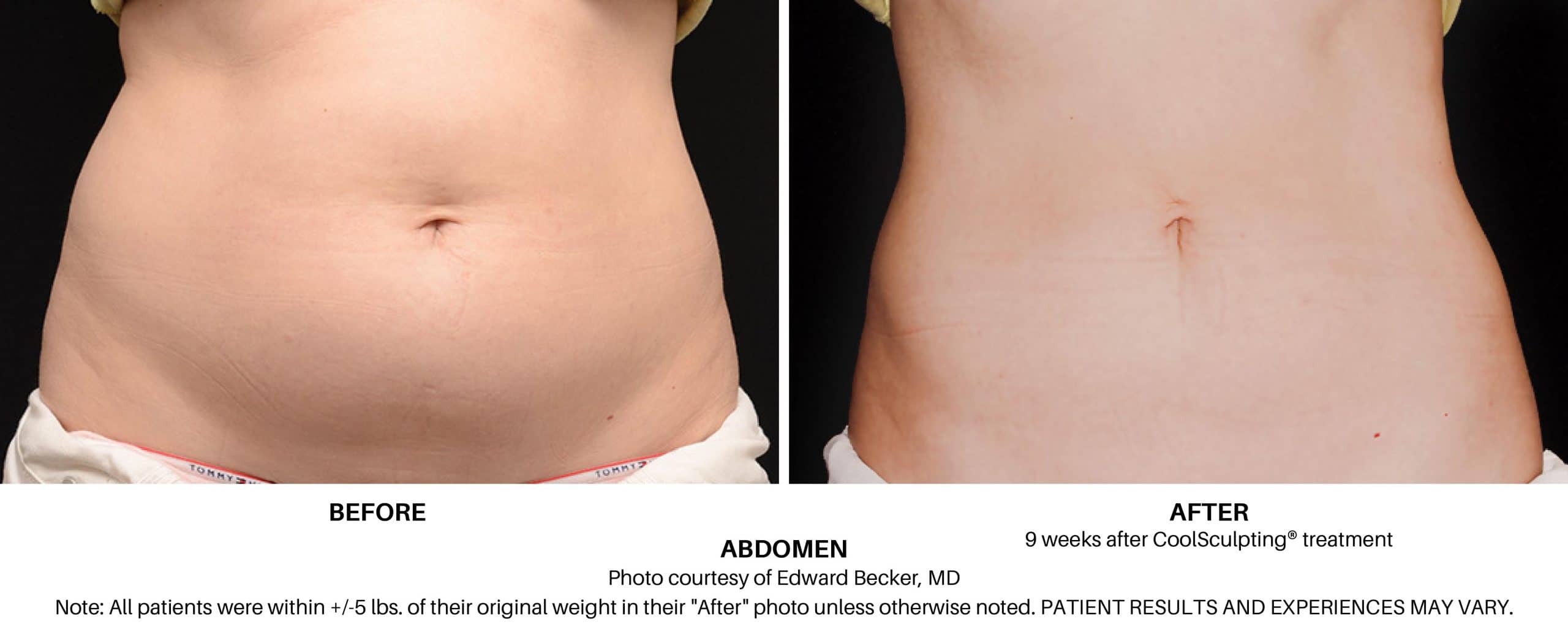 Real CoolSculpting Results: Before and After Photos of Fat-Freezing Success