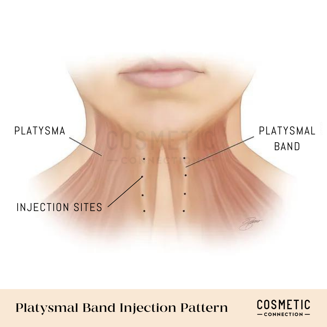 platysmal bands