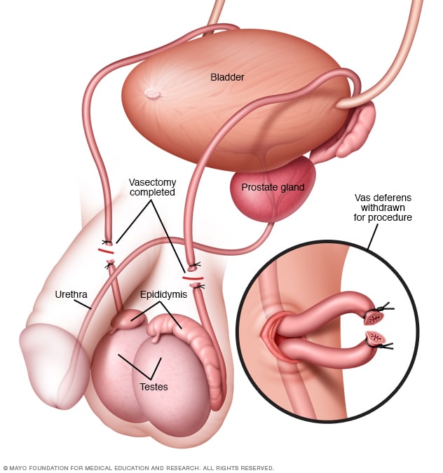 Need a Vasectomy? Find a Doctor Close to You