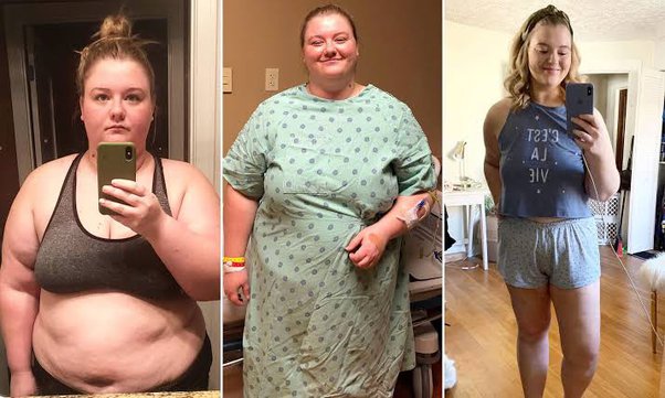 Gaining Weight on Depo? Tips to Manage It