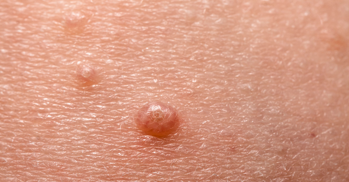 Molluscum Contagiosum Specialists: Who Are They and Where to Find Them