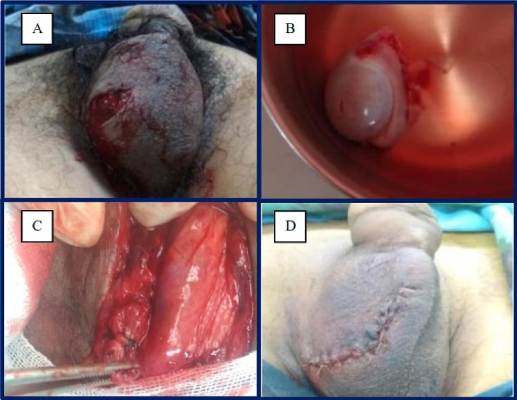 What Happened to Mutilated Penises? Heres What We Know