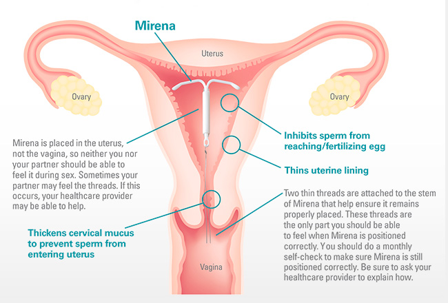 Mirena and low sex drive: Understanding the connection, and getting help.