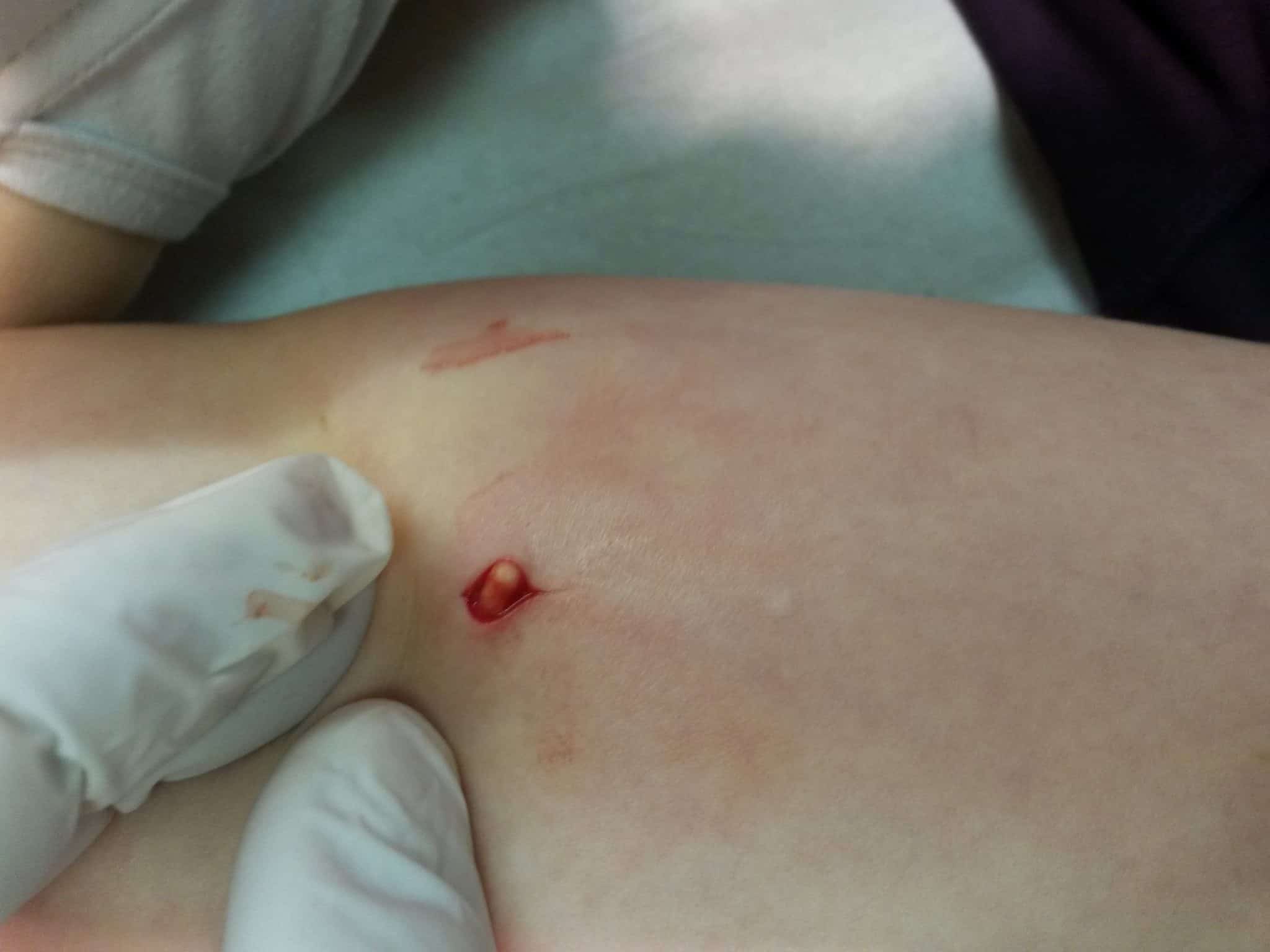 Starting Your First Period After Nexplanon Insertion: A Simple Guide for You