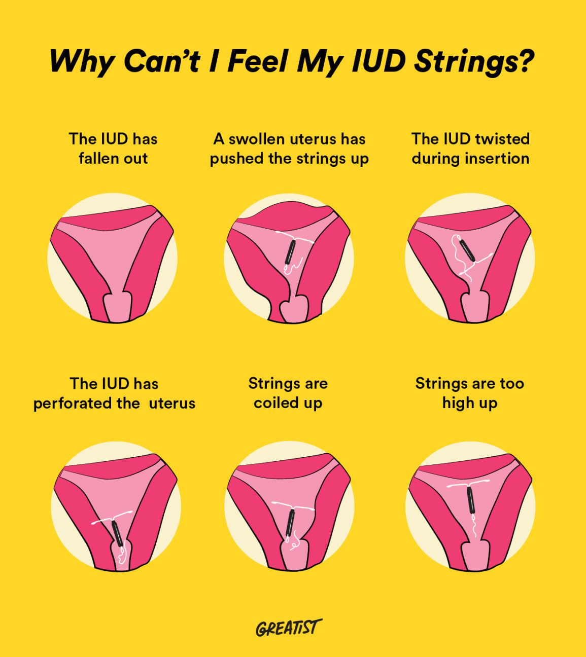 Is Your IUD Expired? Heres How to Tell and Common Expired IUD Symptoms