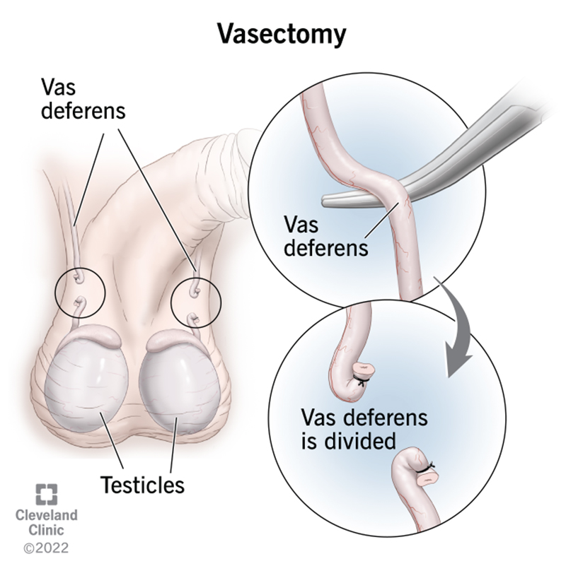 Vasectomy for Men Near Me: A Simple Guide to Costs, Recovery, and What to Expect