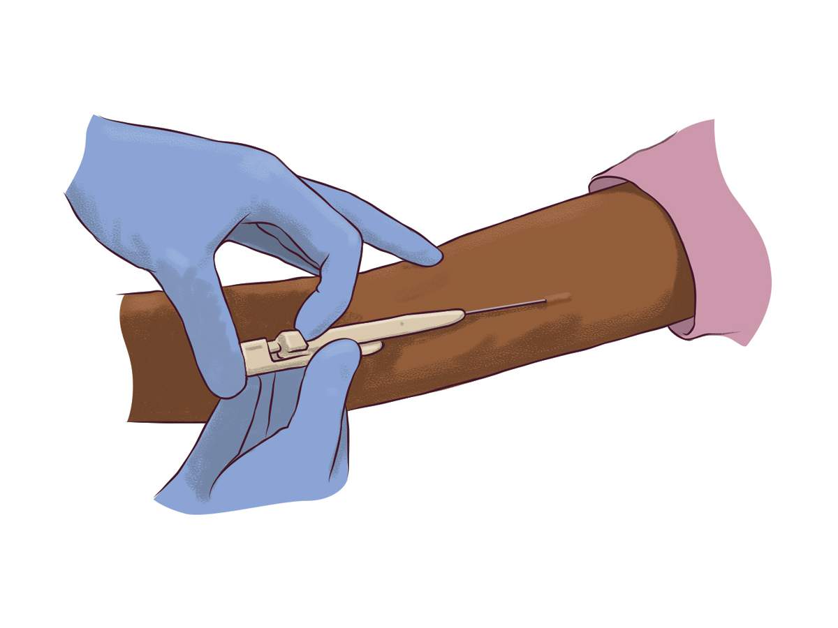 Need Nexplanon Removal? Can Planned Parenthood Remove Nexplanon For You?