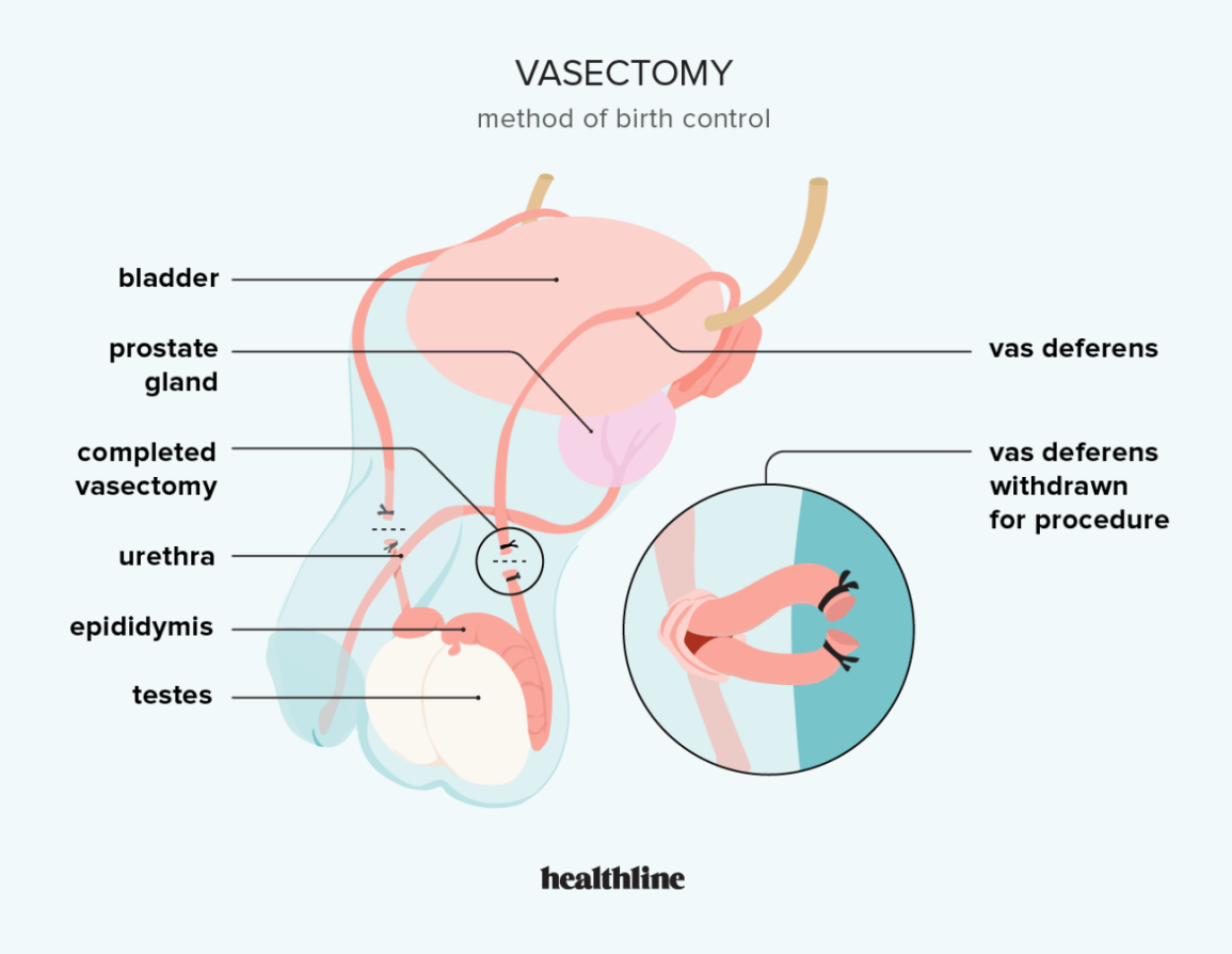 Where Can I Get a Vasectomy? A Simple Guide to Finding Options