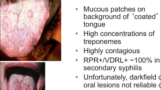 syphilis and tongue problems are linked(Heres what you need to know about the oral signs)?