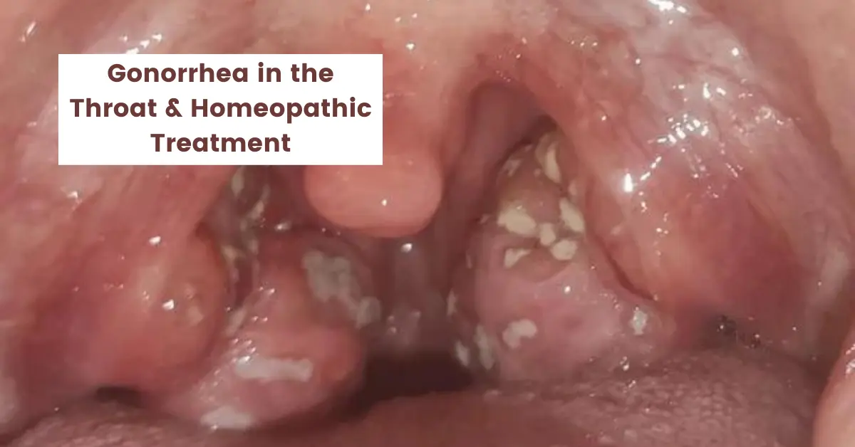 Think You Have Strep Throat? It Could Be Oral Gonorrhea