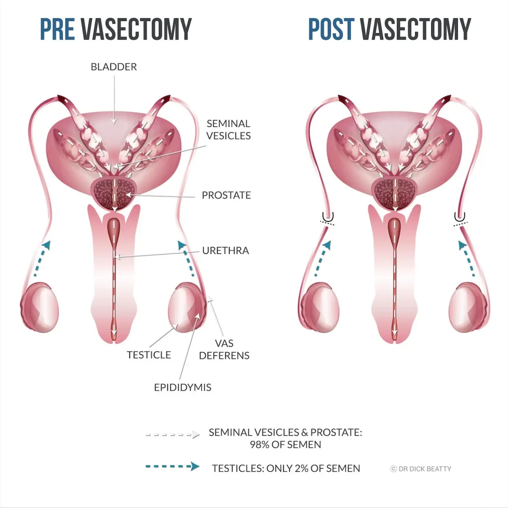 Where Can I Get a Vasectomy? A Simple Guide to Finding Options