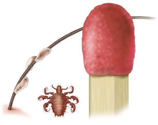 Is it C.R.A.B. infection? Learn how to identify and get rid of it effectively