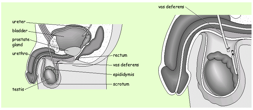 Understanding Vasectomy Procedure Cost: A Simple Guide to Average Prices