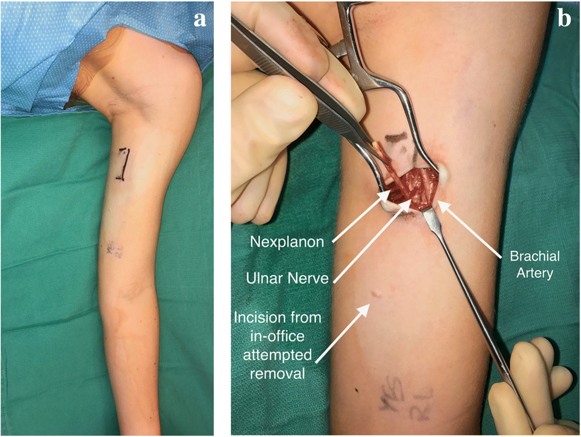 Can I Get Nexplanon Removed at Planned Parenthood? Heres What You Need to Know