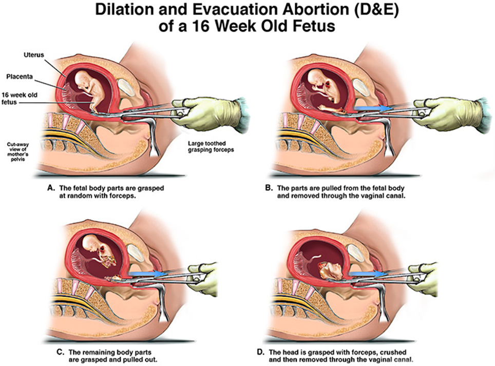Do Abortions Hurt? Understanding the Procedure and Pain