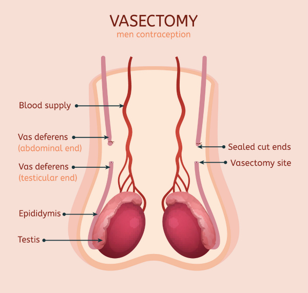 Will a Vasectomy Cause Erectile Dysfunction? Addressing Concerns About This Issue.