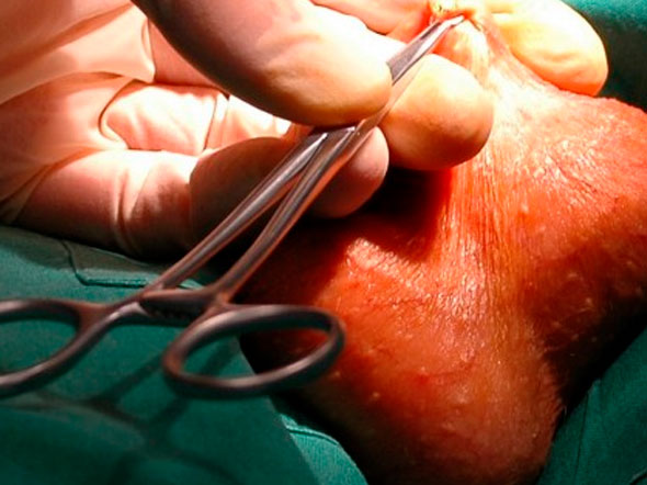 vasectomia near me: Get It Done Fast - Find the Closest Clinic Now