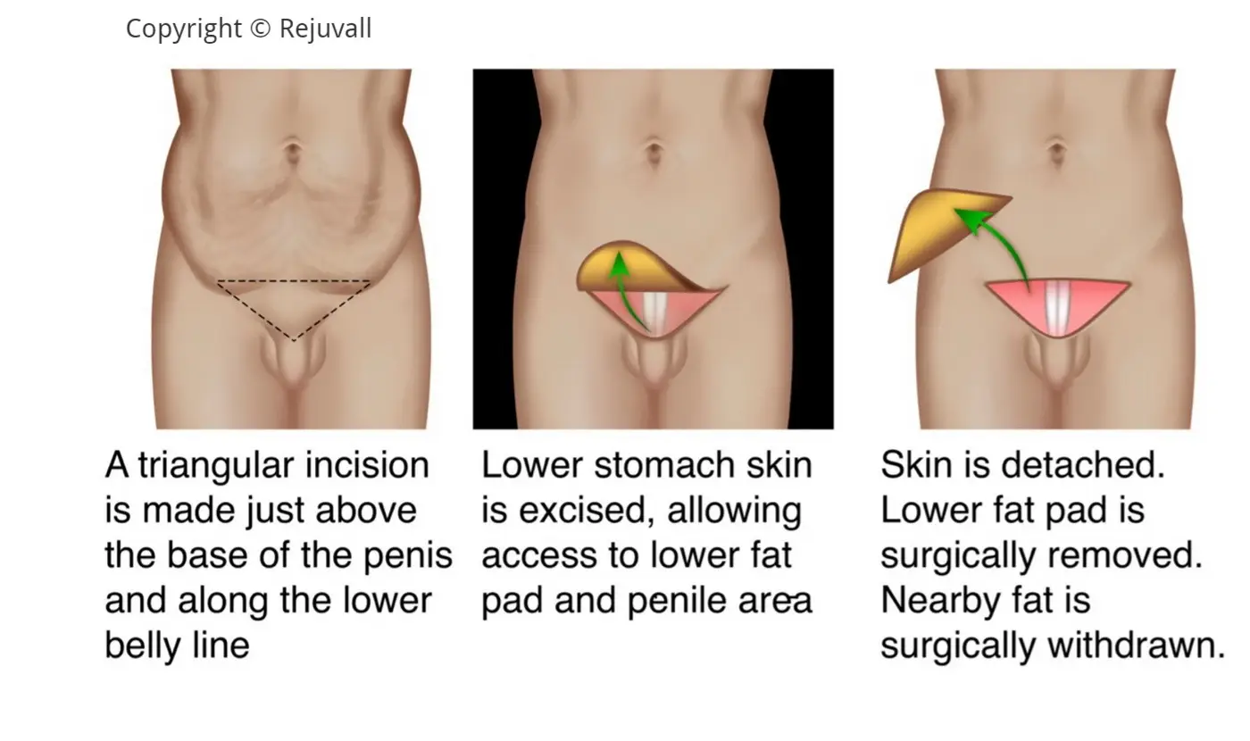 Exploring the Worlds Smallest Pennis: Causes and Treatments