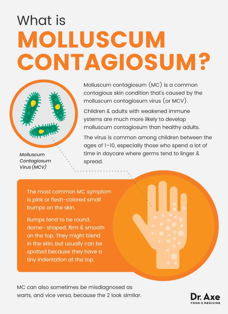 Molluscum Contagiosum Specialists: Who Are They and Where to Find Them