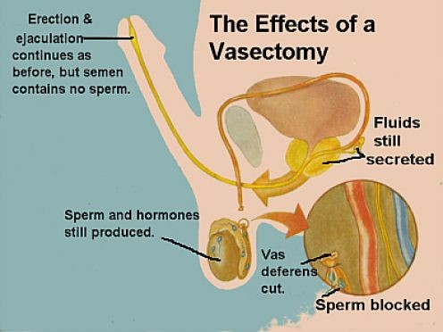 Understanding Vasectomy Procedure Cost: A Simple Guide to Average Prices