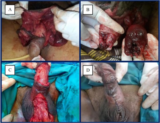 What Happened to Mutilated Penises? Heres What We Know