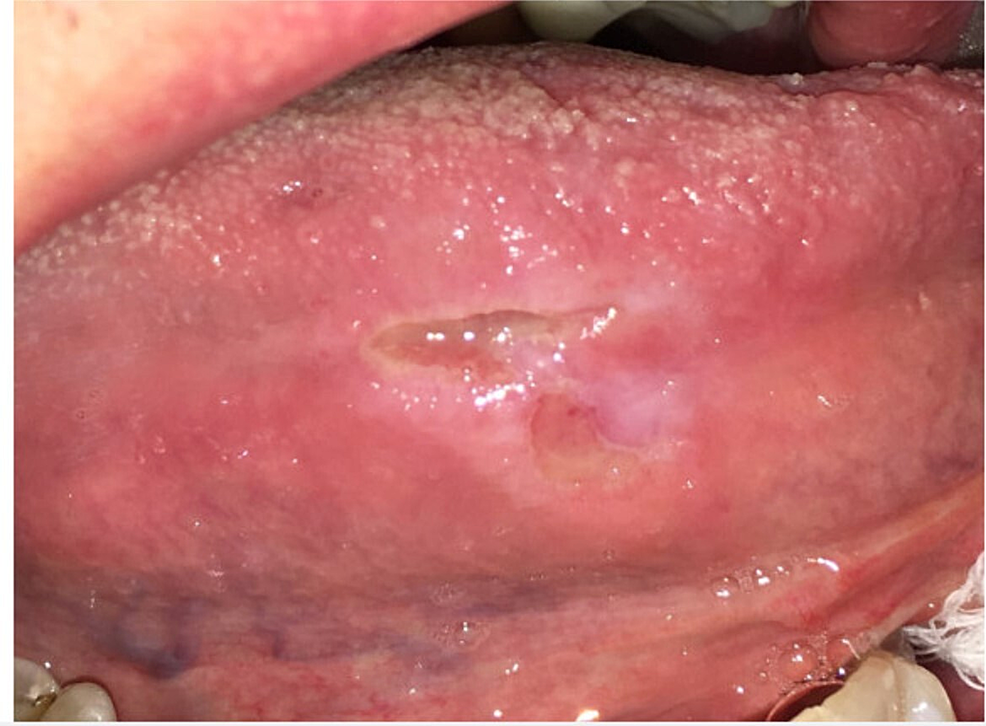 syphilis and tongue problems are linked(Heres what you need to know about the oral signs)?