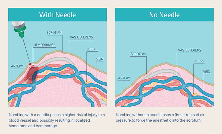 Thinking About a Vasectomy? Heres How Much It Costs