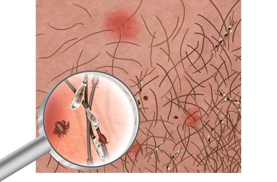 Is it C.R.A.B. infection? Learn how to identify and get rid of it effectively