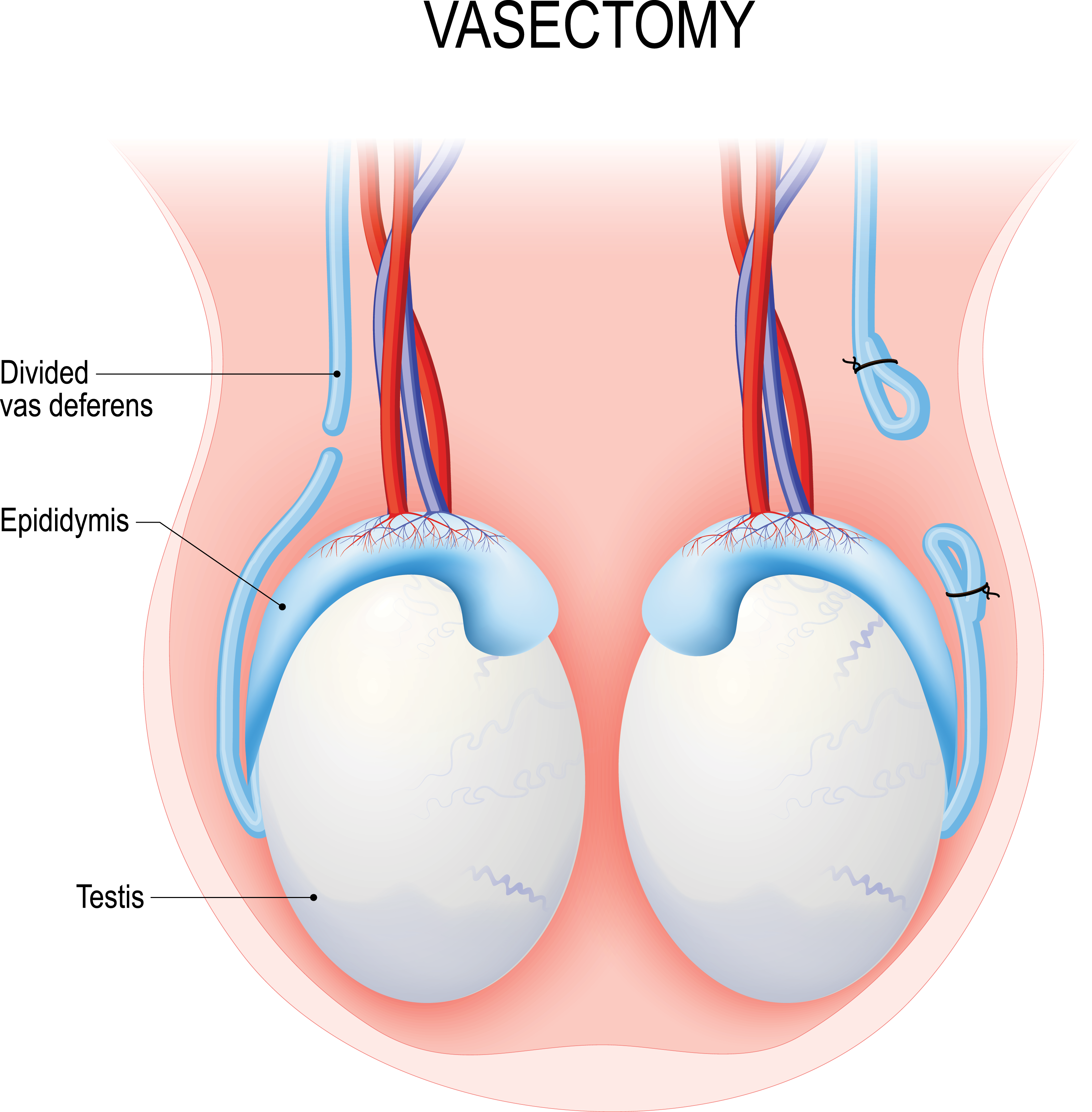Vasectomy Cost: How Much Does It Really Cost? Heres a Breakdown!