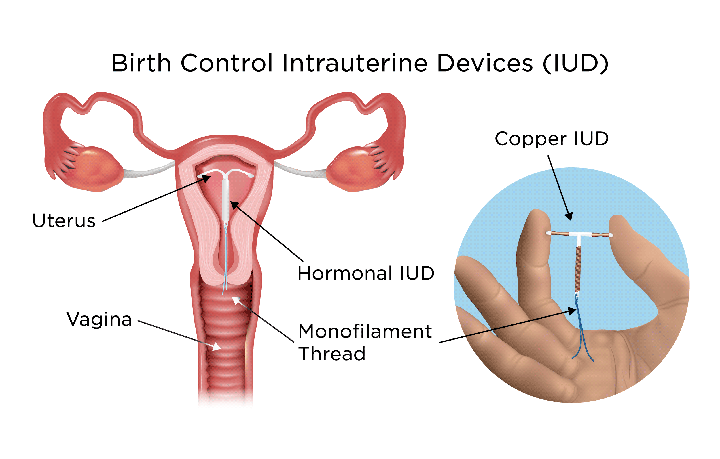 Using Mirena While Nursing: A Quick and Simple Guide