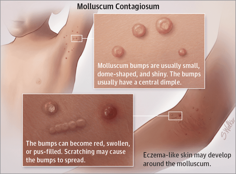 Molluscum Contagiosum Specialists: Who Are They and Where to Find Them