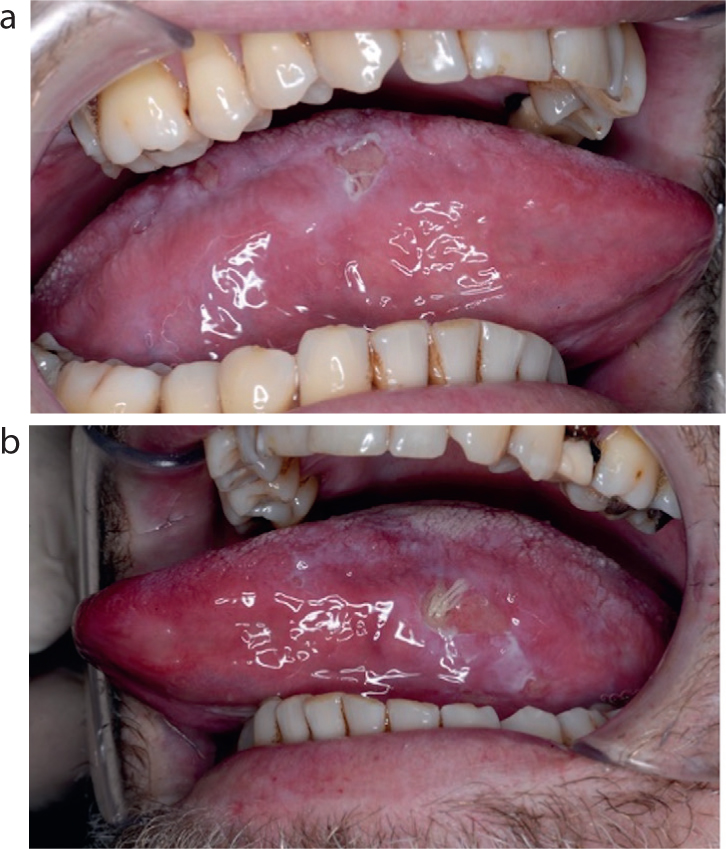 syphilis and tongue problems are linked(Heres what you need to know about the oral signs)?