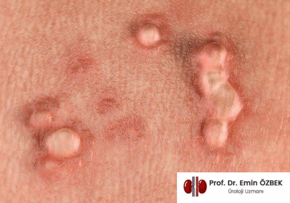 What Causes Genital Warts? Simple Tips to Protect Yourself and Partner
