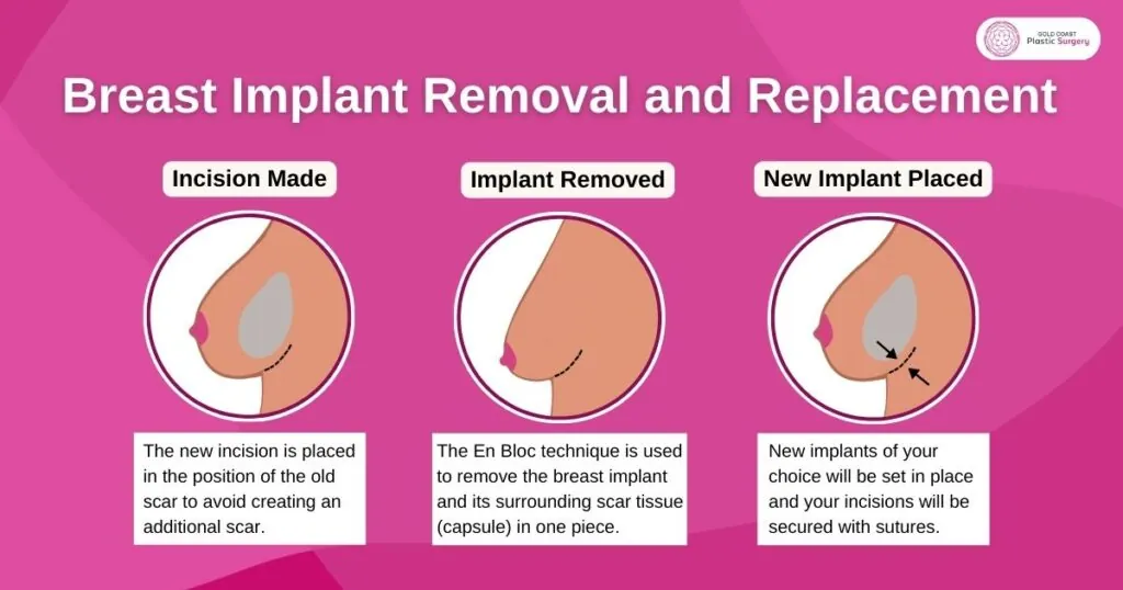 Removed implants: A simple guide to your recovery process.