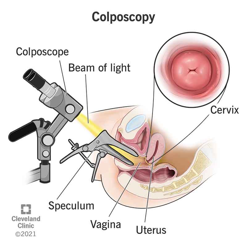 Can you bathe after a colposcopy biopsy? Dos and donts for healing.