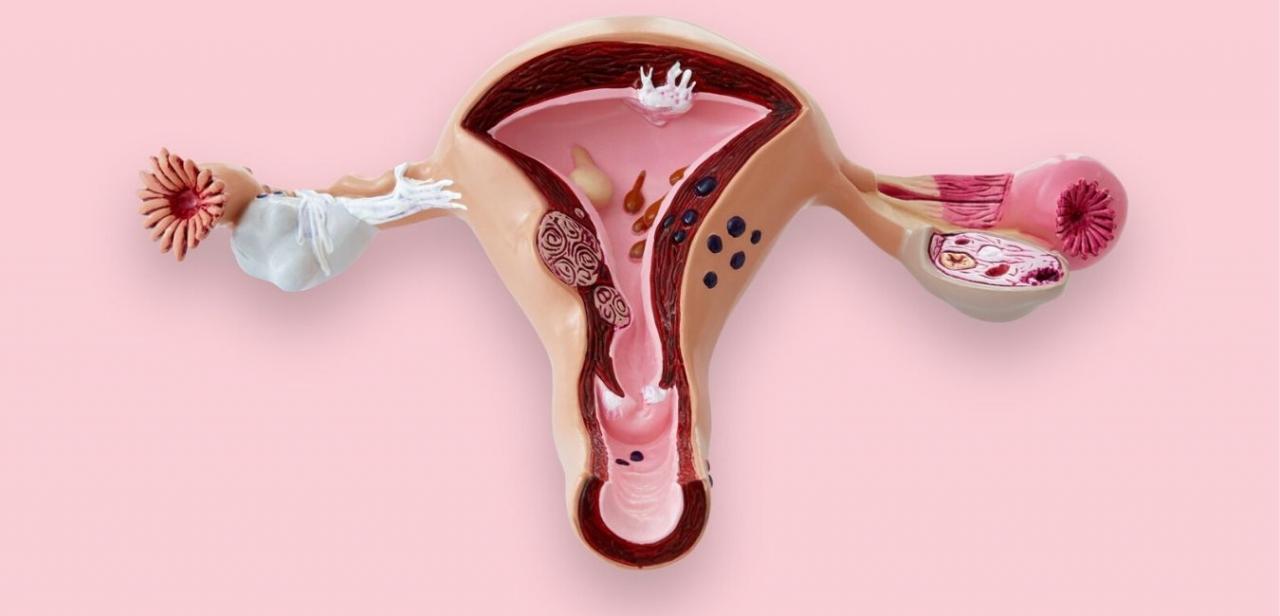 Mirena IUD and Low Sex Drive: Is There a Connection? Simple Ways to Get Your Desire Back