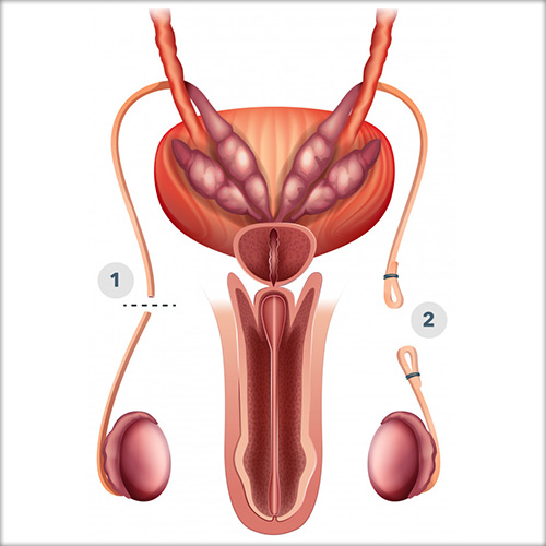 How Much Is a Vasectomy? Find Out the Typical Costs and Ways to Save Money on This Procedure
