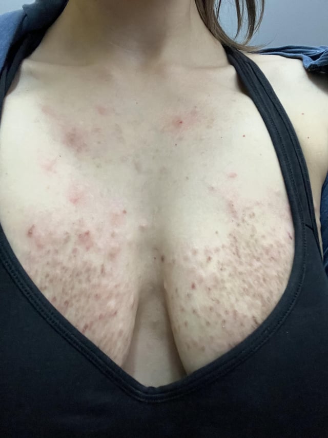 tits bitten is there any good way? Try these quick solutions!